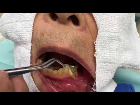 【内藤歯科】歯周病を放っておくとこうなる！末期の歯周病の動画
