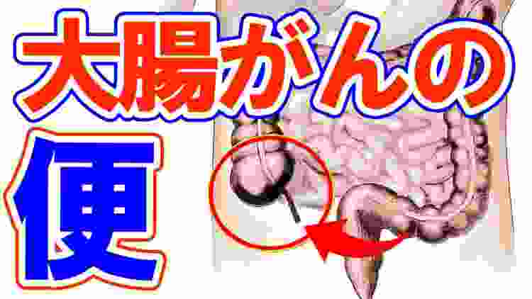 【今すぐ確認】大腸がんの便はココが違う？毎年6万人の日本人が発症する身近な病！